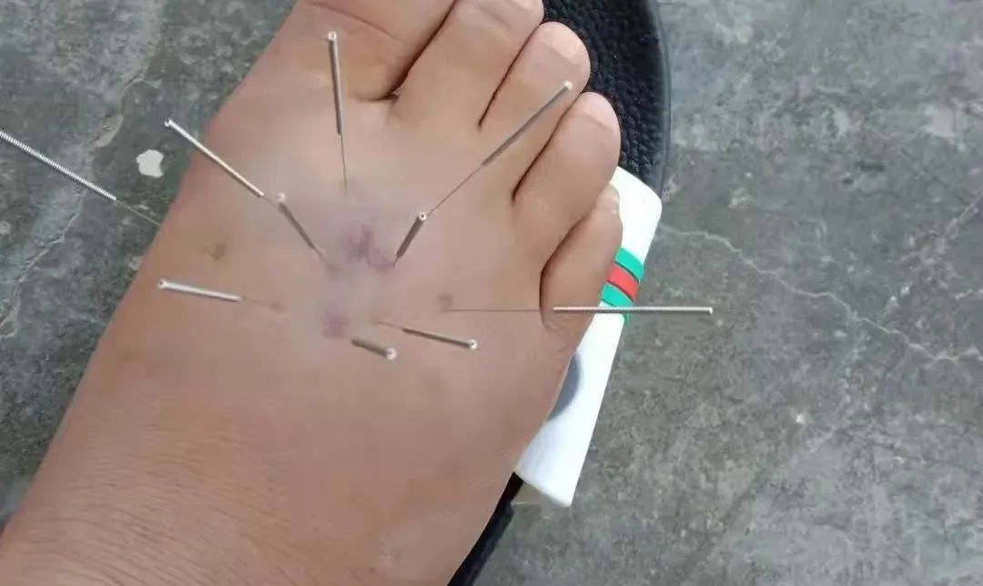 让夺石东筋疲力尽,在砍竹子时,一不小心被一棵倒下的竹子压到了右脚背